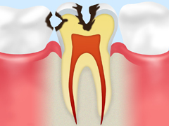 C2：象牙質に達した虫歯
