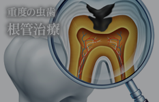 重度の虫歯 根管治療