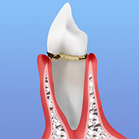 歯周病の進行段階と症状別治療法