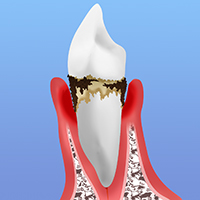 歯周病の進行段階と症状別治療法