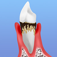 歯周病の進行段階と症状別治療法