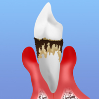 歯周病の進行段階と症状別治療法